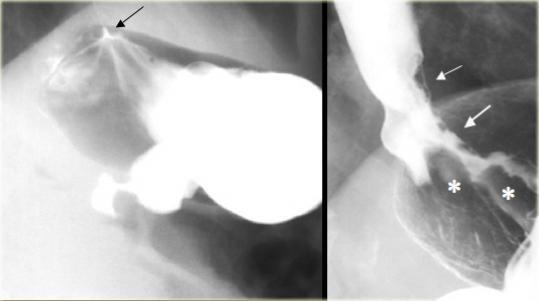 Normal gastroesophageal junction (left), Fundal adenocarcinoma invades esophagus (right)