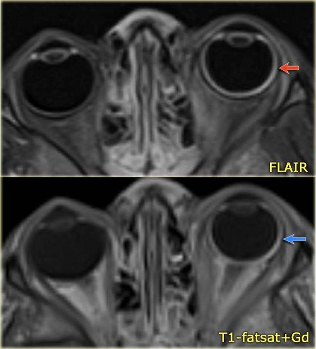 Sturge-Weber. Axial FLAIR and CE-T1WI with fatsat. Diffuse choroidal hemangioma