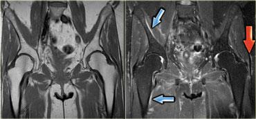 Lipitor myositis Coronal T1-weighted and T2-weighted with fatsat
