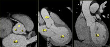 Axial (left) reconstruction, 3-chamber view (middle) and coronal reconstruction (right) of the heart illustrating the relationships between the left atrium, ventricle and aortic root. LA=left atrium, R=right coronary cusp, L=left coronary cusp, N=non-coronary cusp, Ao=aorta, LV=left ventricle