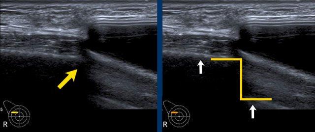 Step off sign in silicone prosthesis