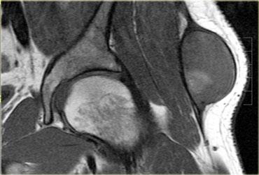 Morel-Lavallee lesion