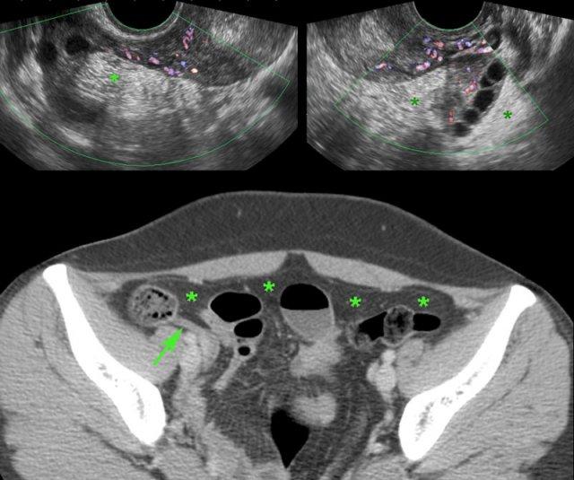 PID giai đoạn sớm.