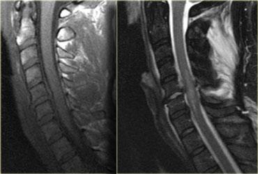 Hyperflexion sprain with spinal cord injury