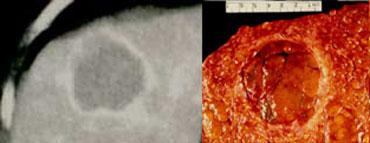 TRÁI: Bao xơ ngấm thuốc mạnh của HCC trong thì cân bằng. PHẢI: Tiêu bản bệnh lý đại thể.