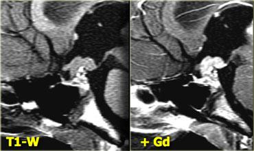 Germinoma (Courtesy of Dr. Susan Blaser)