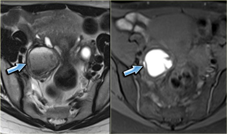 T2- and fatsat T1-images of an endometrioma with hypointensity on T2 (shading), fluid-fluid levels on T2 (left) and hyperintense blood on T1WI with fatsat (right)..