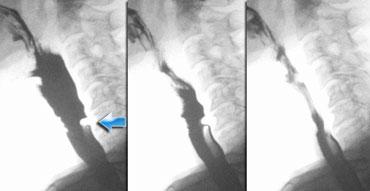 Vết lõm nhỏ của cơ nhẫn hầu. Không gây tắc nghẽn.