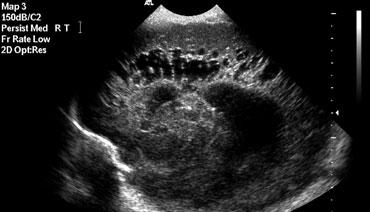 Sagittal image demonstarting extensive PVL grade 3