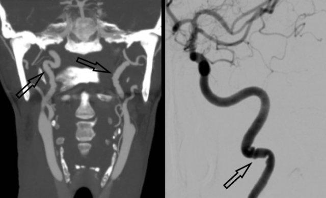 FMD with "string of beads" pattern on MIP CTA and DSA (black arrows)