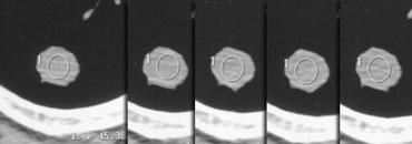 Hình ảnh nền và hình ảnh sau khi tiêm thuốc cản quang. Tổn thương lành tính với