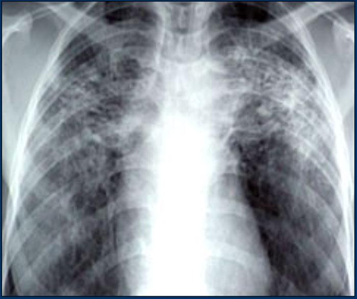 Sarcoidosis with fibrosis in the upper lobes. Typical chest film.