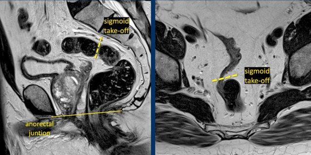 The dashed line indicates the sigmoid take-off on a sagittal and axial view
