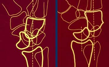 LEFT: Lunate dislocation: capitate is centered over the radius and lunate is tilted out.RIGHT: Perilunate dislocation: lunate is centered over the radius and capitate is tilted out dorsally.