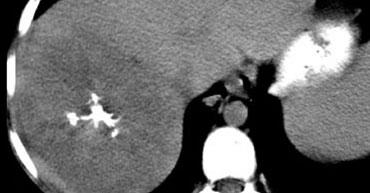 NECT của ung thư biểu mô dạng tấm xơ với vôi hóa trung tâm