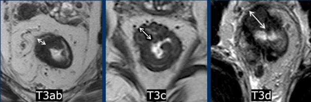 Subclassification of T3 tumors according to invasion depth