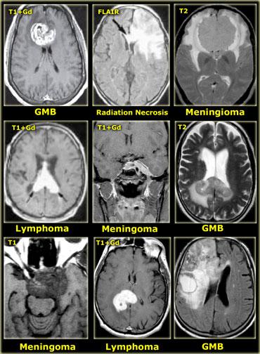 Tumors and tumor-like masses that cross the midline