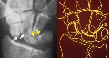 Disruption of the second carpal arc