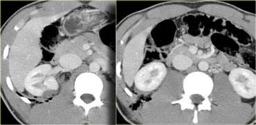 Vết đâm dao ở hông phải