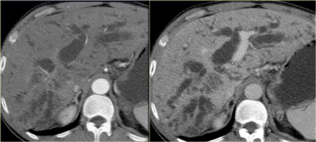 Klatskin Tumor: arterial and portal venous phase