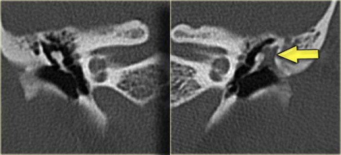 20-year old woman with recurrent otitis. Granulations on left ear drum. Soft tissue mass between ossicular chain and lateral tympanic wall, which is eroded. Right side for comparison.