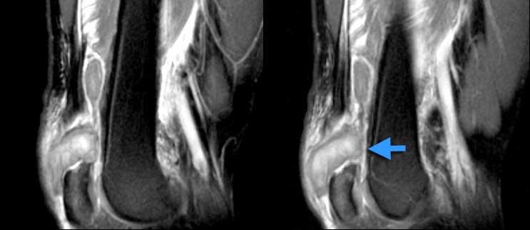 Rách hoàn toàn gân cơ tứ đầu đùi. Ảnh chuỗi xung T2W mặt phẳng đứng dọc. Mất liên tục hoàn toàn. Khối máu tụ ở giữa.