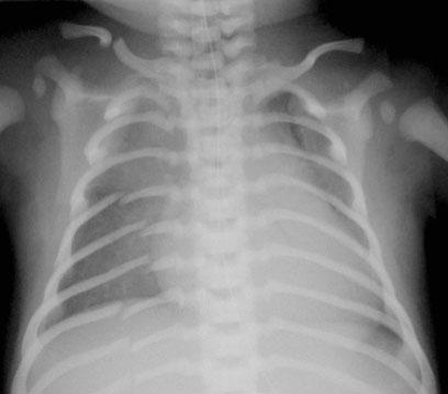 Trẻ 1 ngày tuổi với nhiều gãy xương sau cuộc sinh khó. Cân nặng lúc sinh là 5500 gram.