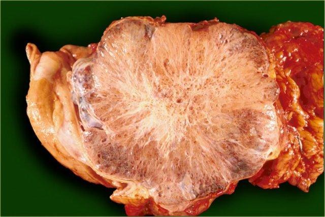 Serous cystic neoplasm with multiple small cysts. Courtesy of Dr Klimstra, pathology of the Memorial Sloan Kettering Cancer Center, NY,