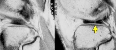Disrupted bow tie indicating a small radial tear.
