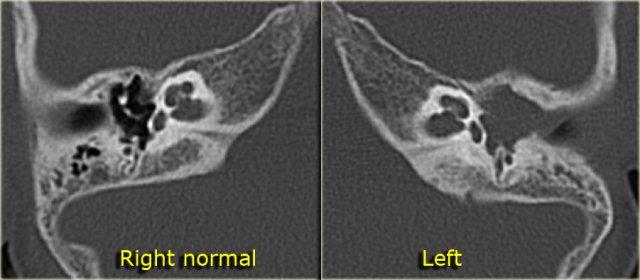 Automastoidectomy due to a large cholesteatoma
