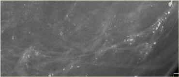 Magnified view: fine pleomorphic calcifications in a linear distribution.  Biopsy: High grade DCIS