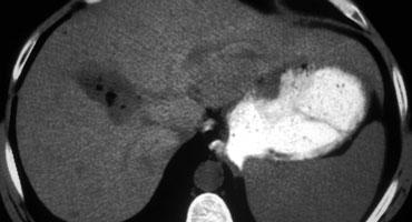 Vùng giảm tỷ trọng do mỡ trong u tuyến