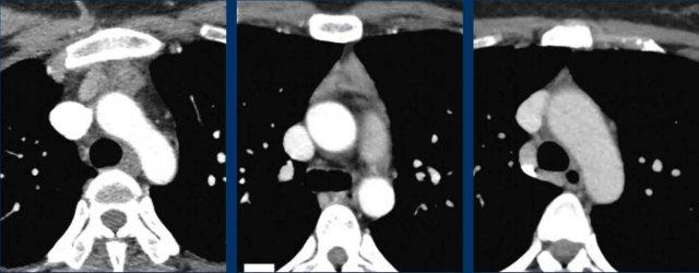 Normal involution of the thymus at age 14, 18 and 24
