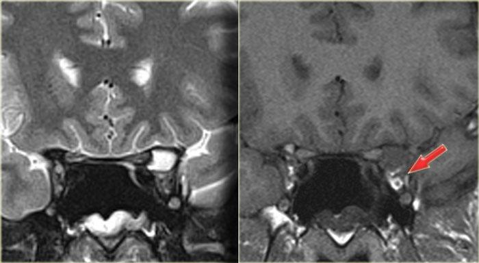 Mucocele of the anterior clinoid with secondary involvement of the optic nerve