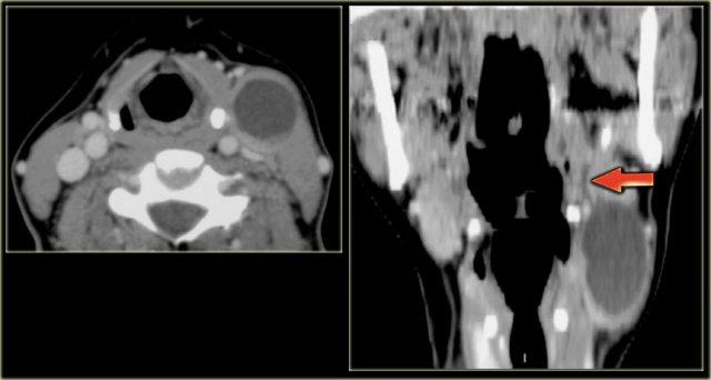 Second branchial cleft cyst: small fistula tract (arrow)