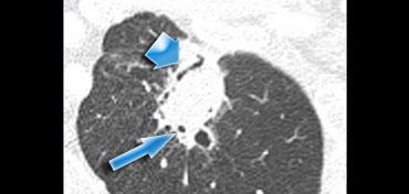 Dấu hiệu phế quản hơi thấy trong