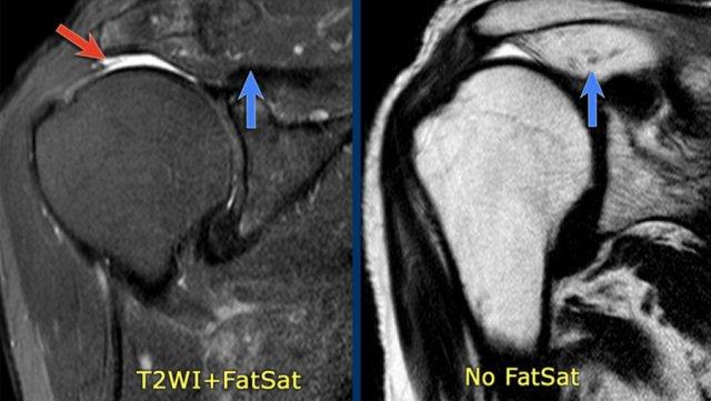 Rách toàn bộ chiều dày không đều.