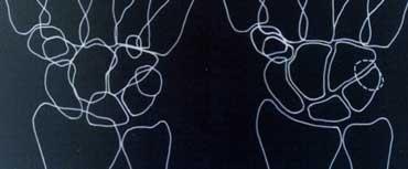 Study the carpal bones as pieces of a jigsaw puzzleLEFT: Schematic representation of the wrist with the outlines tracing the outer margins of the bonesRIGHT: Schematic representation of the wrist with the lines tracing the carpal bones as pieces of a jigsaw puzzle