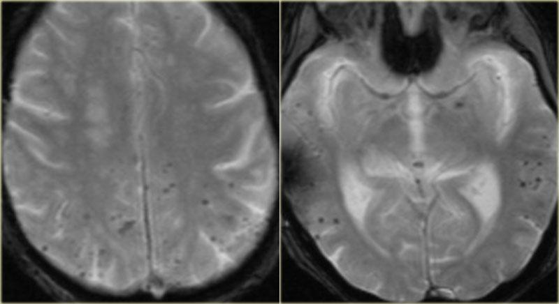 CAA - Multifocal subcortical black dots in a older patient.