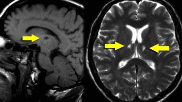 Bilateral medial strategic thalamus infarctions