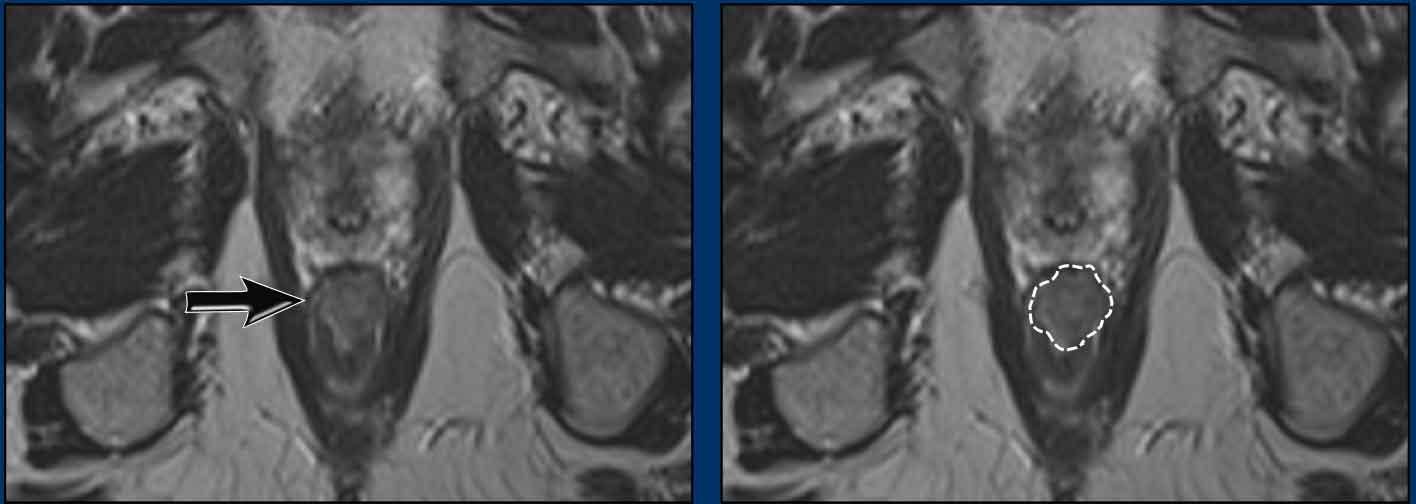 Ung thư hậu môn trước hóa xạ trị