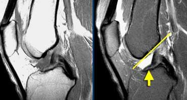 Torn ACL. ACL fibers are too flat (yellow arrow) compared to intercondylar roof (Blumensaat's line).