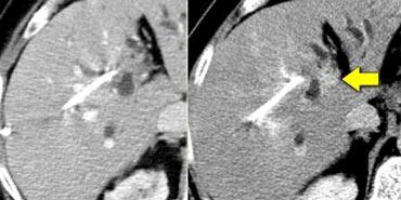 Small cholangiocarcinoma not visible in portal venous phase (left), but seen as relative hyperdense lesion in the delayed phase (right).