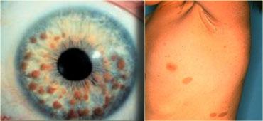LEFT: multiple iris hamartomas (Lisch nodules) RIGHT: axillary freckling (small brown spots) and caf? au lait spots