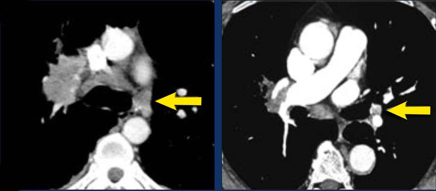 Two patients with N3-disease.