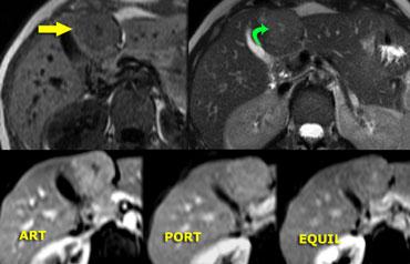 FNH điển hình trên MR