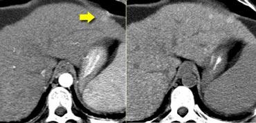 Arterial phase (left) and NECT (right)