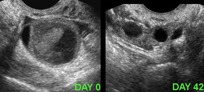 Nang xuất huyết tồn lưu.