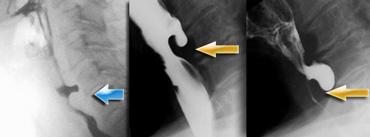 TRÁI: túi thừa nhỏ. GIỮA và PHẢI: túi thừa Zenker thực sự do đóng sớm của cơ nhẫn hầu (mũi tên vàng)