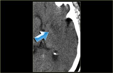 Mờ nhân đậu hoặc hạch nền mờ ranh giới